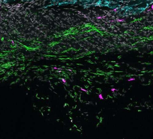 Newly discovered skin cell may underlie inflammatory skin disease
