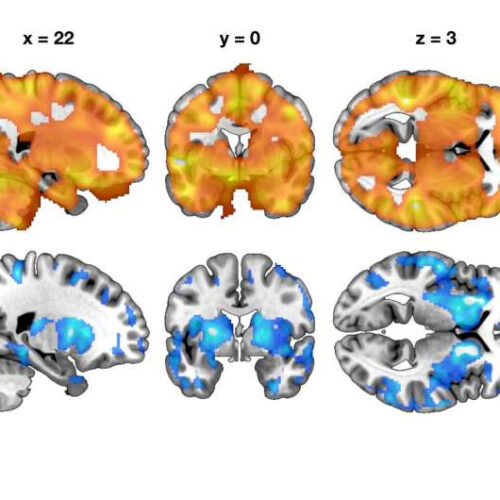 Brain reveals the risk for developing obesity