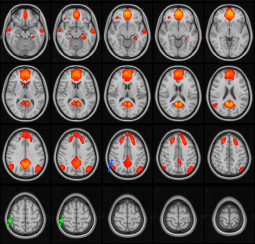 Multiple concussions can disrupt brain connectivity in teens