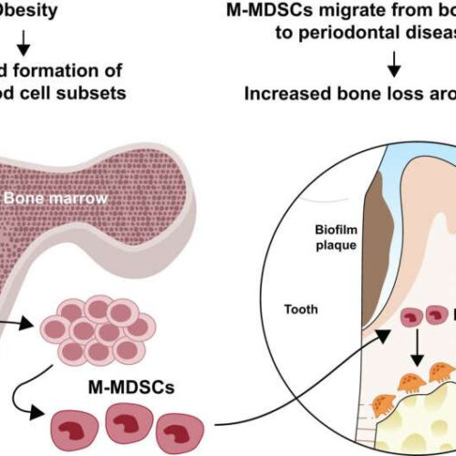 Obesity raises the risk of gum disease by inflating growth of bone-destroying cells