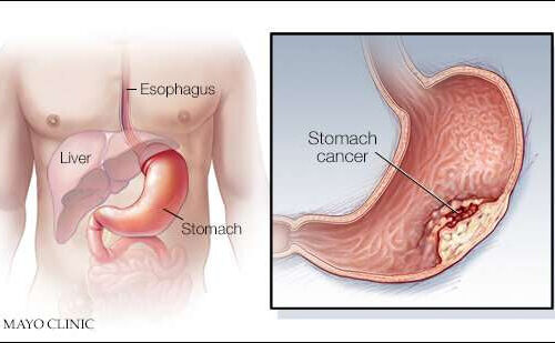 What’s new in gastric cancer treatment and research