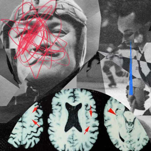 Everyday people fear they have CTE. A dubious market has sprung up to treat them