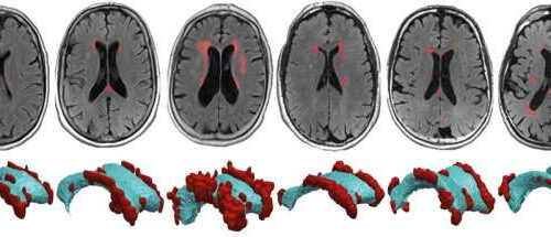 Wear and tear in vulnerable brain areas lead to lesions linked to cognitive decline