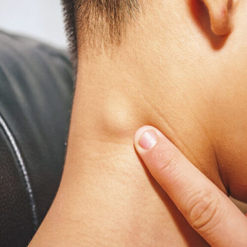 Thyroid nodule symptoms, treatment, causes, and all else you need to know