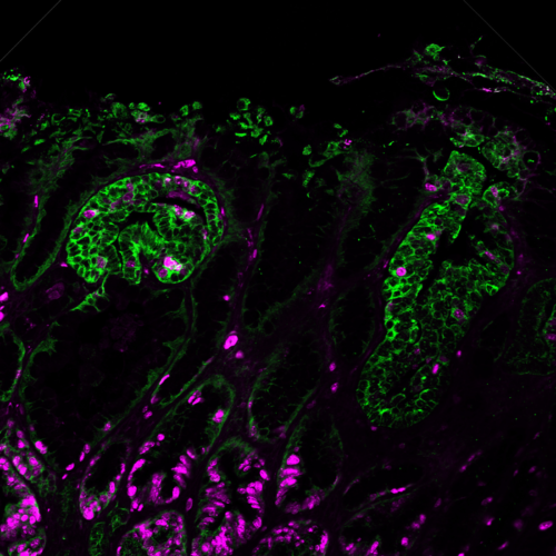 New preclinical models help identify stem cells that drive gastric cancer growth and spread