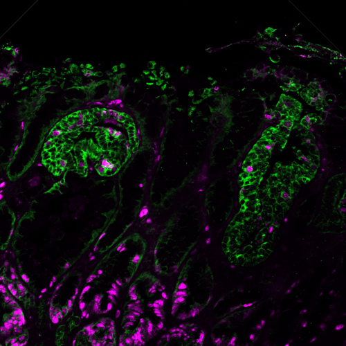 New immunotherapy for leukemia discovered