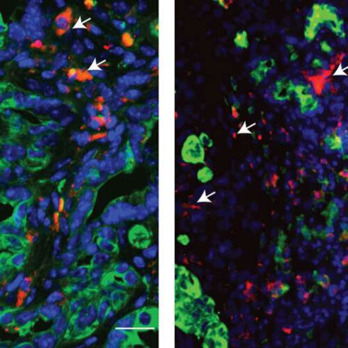 Drug compound makes pancreatic cancer cells more vulnerable to chemo