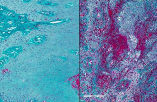 Disarming a blood-clotting protein prevents gum disease in mice