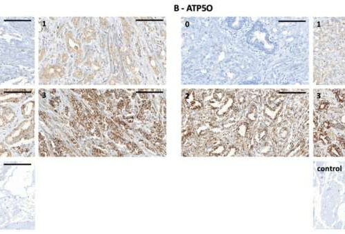 Two proteins identified as novel markers of greater prostate cancer aggressiveness