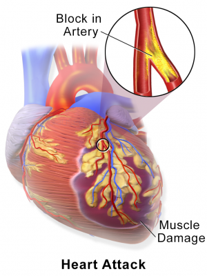 New study could inform treatment and prevent heart attack in diabetic patients