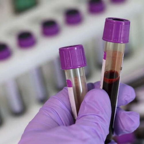 New blood test can identify if a patient has cancer and if it has spread