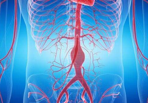 Mechanical basis for abdominal aortic embolism discovered