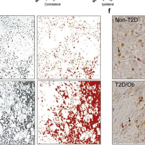 Weight loss may repair the brain after stroke in diabetes