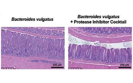 Stool samples reveal microbial enzyme driving bowel disease