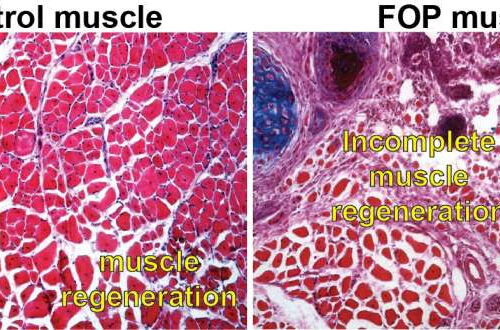 Origin of rare disease FOP rooted in muscle regeneration dysfunction