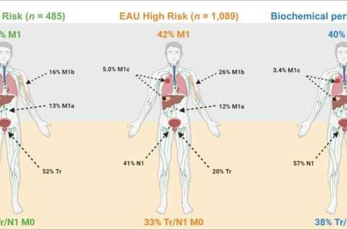 PSMA PET validates EAU classification system to determine risk of prostate cancer recurrence