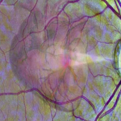 Using the eye as a window into heart disease