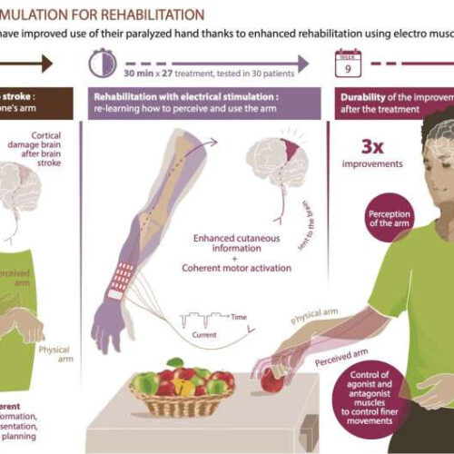 Improved motor, sensory, and cognitive recovery of hand and arm function after stroke