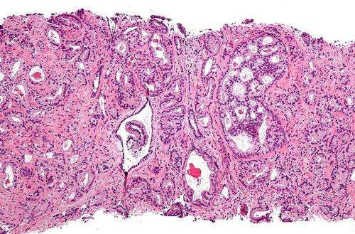 Early prostate cancers can harbor aggressive tumor cells
