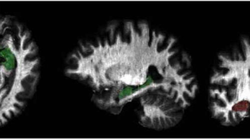 Anxiety and PTSD linked to increased myelin in brain’s gray matter