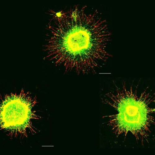 In Down syndrome cells, genome-wide disruptions mimic a senescence-like state