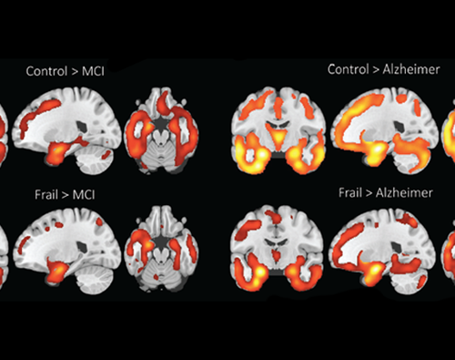 Cognitive decline not always a sign of Alzheimer’s disease