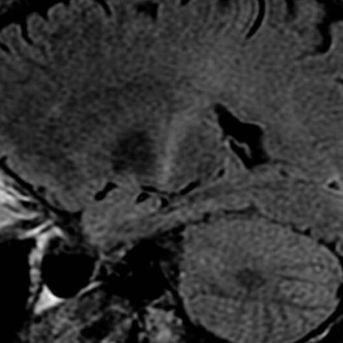 Astrocyte studies reveal harmful changes in Amyotrophic Lateral Sclerosis