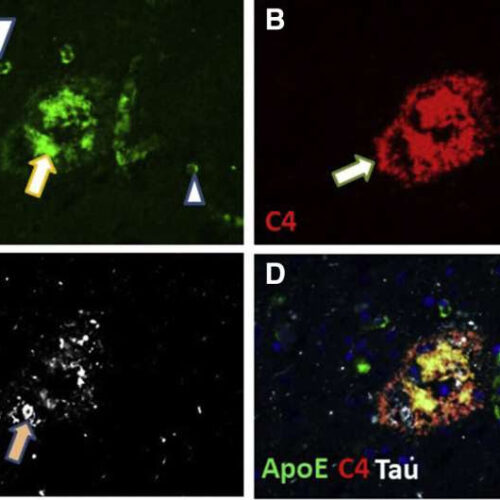 Study now links non-mutated Apolipoprotein E to dementia in the aging brain