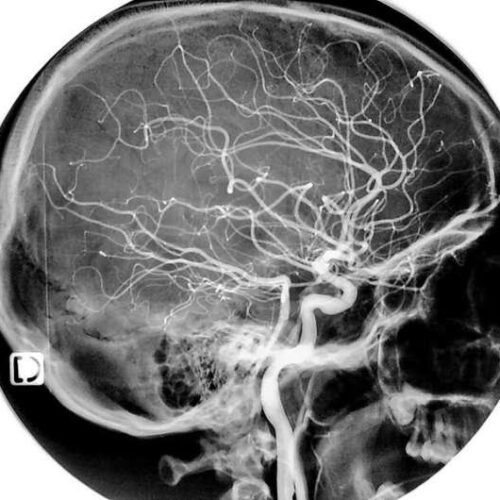 ‘Cell atlas’ of brain vasculature connects stroke with novel immune cells