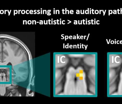 The neural mechanisms behind autism: Altered sensory processing of communication signals