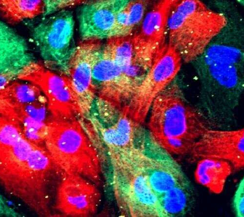 Scientists target protein to lower risk of prostate cancer spread