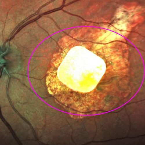 Implanted chip, natural eyesight coordinate vision in study of macular degeneration