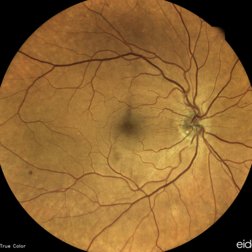 Eye provides clues to insidious vascular disease