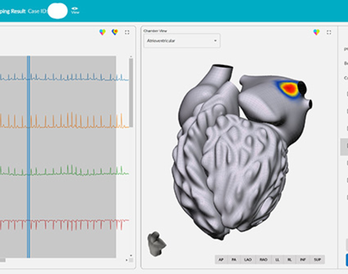 Remapping atrial fibrillation treatment