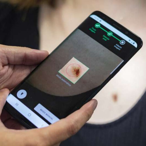 A mobile app and AI software to speed up skin-cancer diagnoses