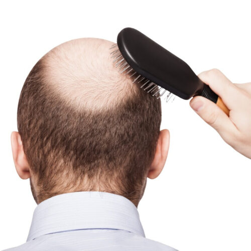 dNovo’s novel baldness treatment takes a direct route to hair regrowth
