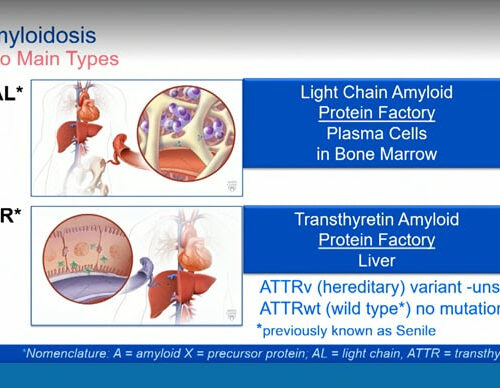 Transthyretin Amyloid and New Treatment Options
