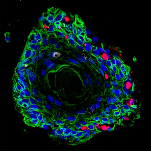 Cancer: When viruses and bacteria cooperate