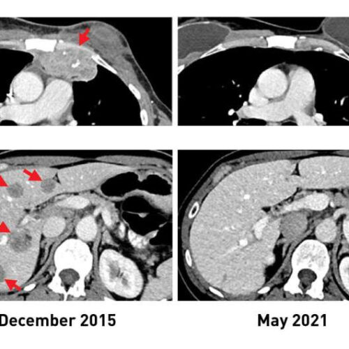 Study advances personalized immunotherapy for metastatic breast cancer