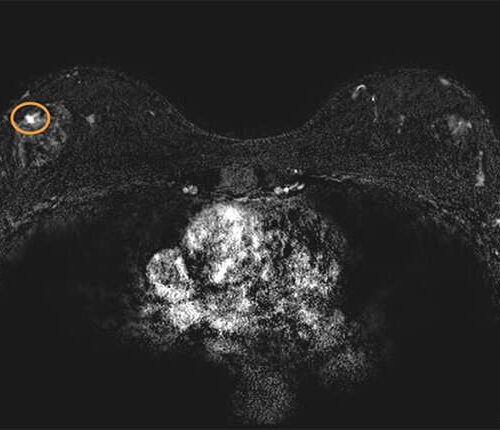 MRI may lower breast cancer deaths from variants in 3 genes