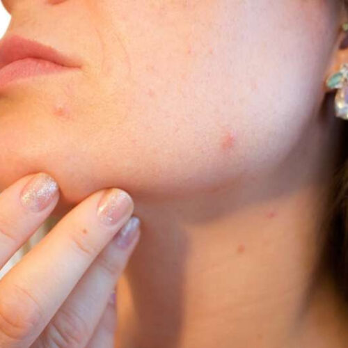 Discovery of 29 new acne risk genes provides hope for new treatments