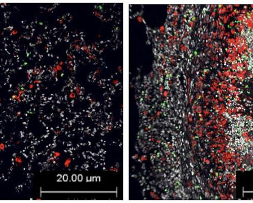 Starting antiretroviral therapy early is essential to battling not one, but two killers