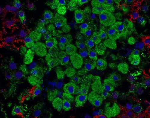 New diabetes targets could allow protection of pancreatic beta cells