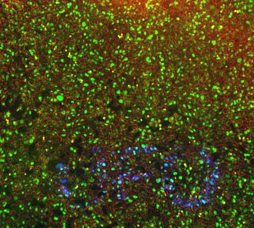 Detecting aggressive cancer cells via real-time optical tagging and image analysis