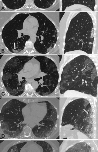 Lung damage may persist long after COVID-19 pneumonia