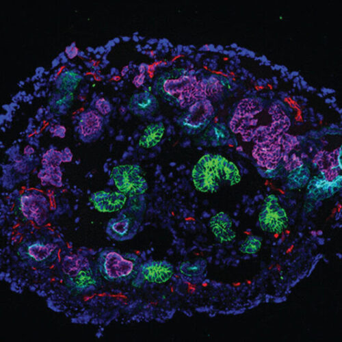 Organoids reveal the tipping point when kidney damage turns irreversible