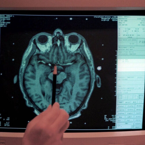 Brain shrinkage, tissue damage, cognitive disruption. What COVID can do to patients’ brains