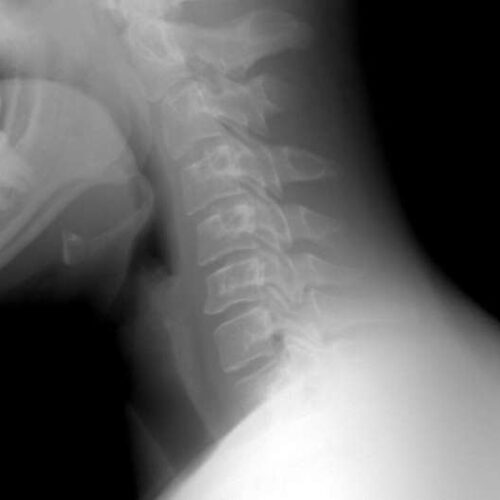 Simple clinical tool to diagnose spinal fractures in people with osteoporosis