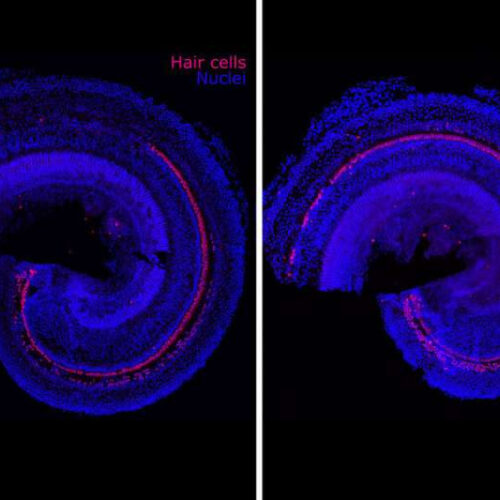 Reversing hearing loss with regenerative therapy