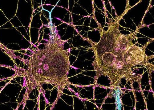 Scientists uncover new targets for treating Parkinson’s disease